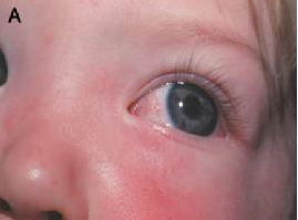 التهاب العين في مرض كاواساكي