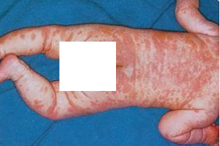 الطفح الجلدي في مرض كاواساكي