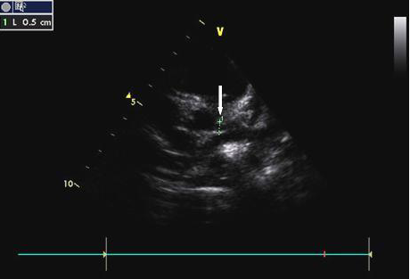 تخطيط صدى القلب ثنائي الأبعاد يظهر تمدد الشريان التاجي الأيسر في مرض كاواساكي