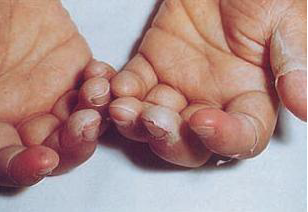 تمزق جلد اليدين في مرض كاواساكي